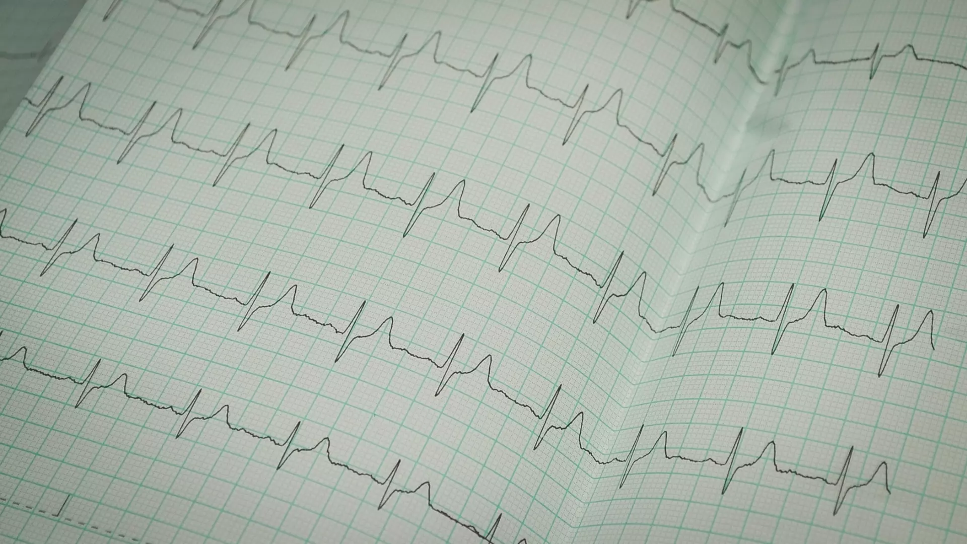 Дела сердечные: тюменский врач-кардиолог рассказывает, как избежать инфаркта